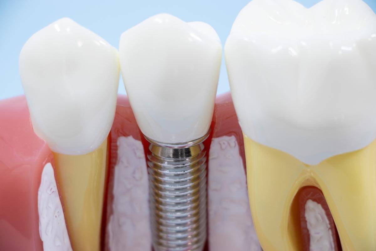 インプラントのやり方を徹底解説！手術の流れから治療方法まで詳細まとめ