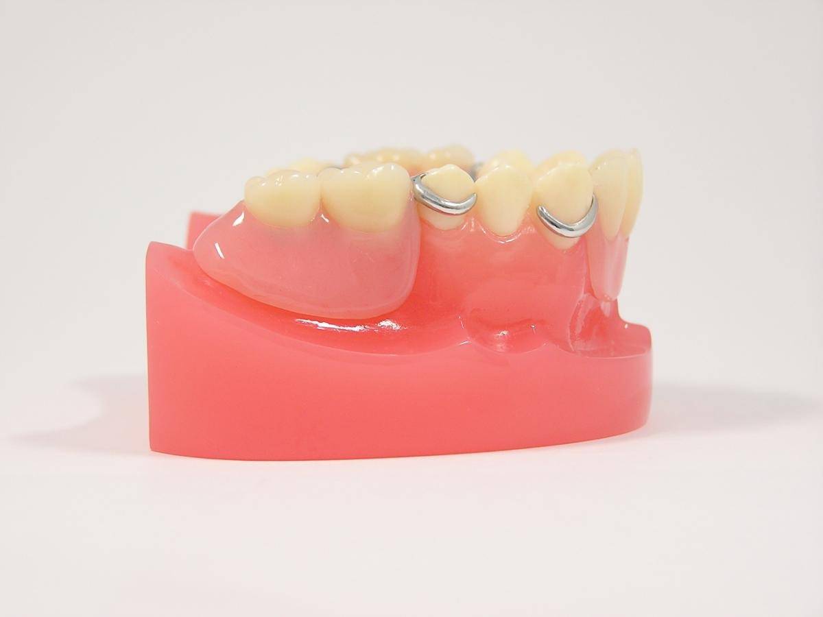 インプラントと入れ歯の併用治療法とは？メリットと最適な選び方
