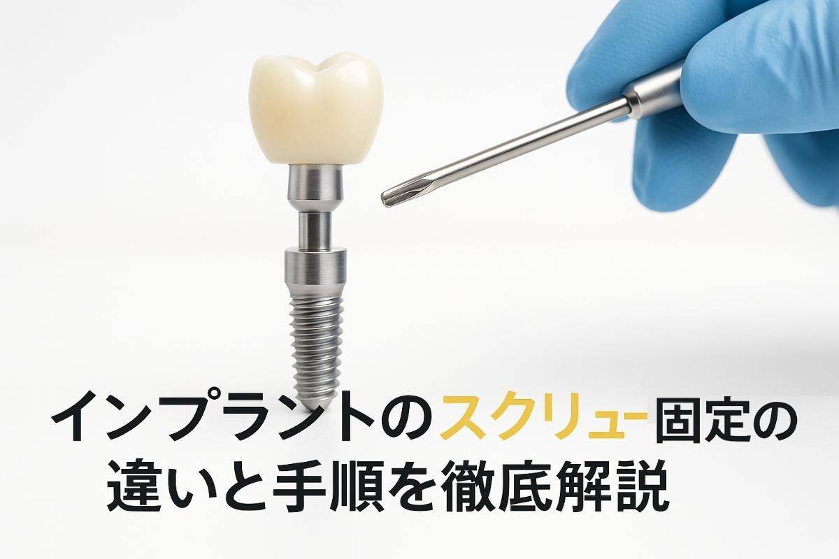 インプラントのスクリュー固定の違いと手順を徹底解説｜メリット・デメリットや費用相場もわかる