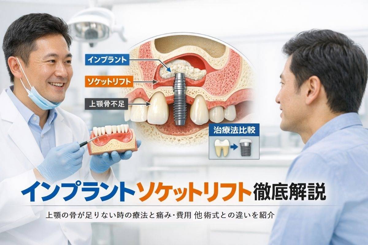 インプラントソケットリフトとは何か上顎の骨が足りない時の治療法を徹底解説｜痛み・費用・他術式との違いもわかるガイド
