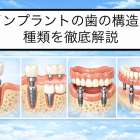 歯のインプラントとは何か？治療の流れとメリットデメリット比較