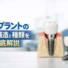 インプラントの歯の構造と種類を徹底解説